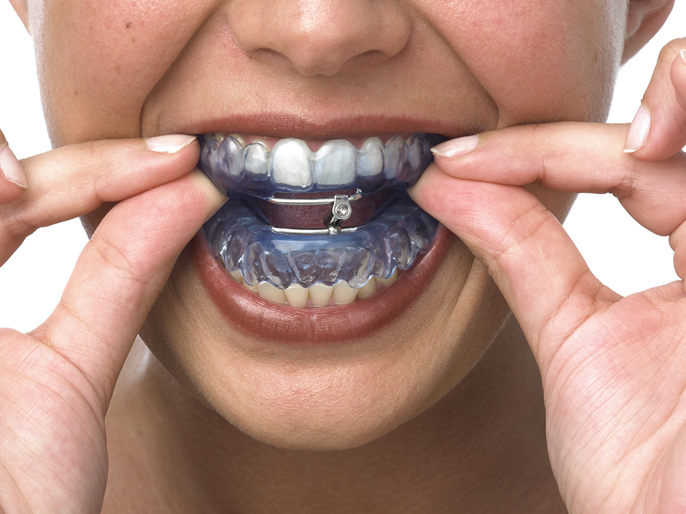 Archivo:Dispositivo de avance mandibular Orthoapnea.jpg - Wikipedia, la  enciclopedia libre